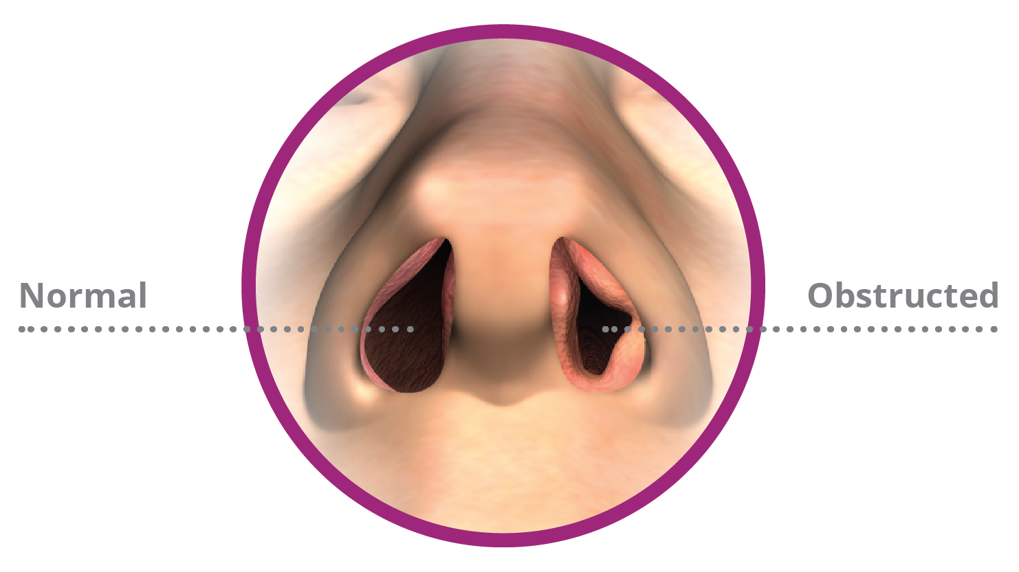 VivAer Nasal Airway Remodel Peoria Ear Nose Throat Group